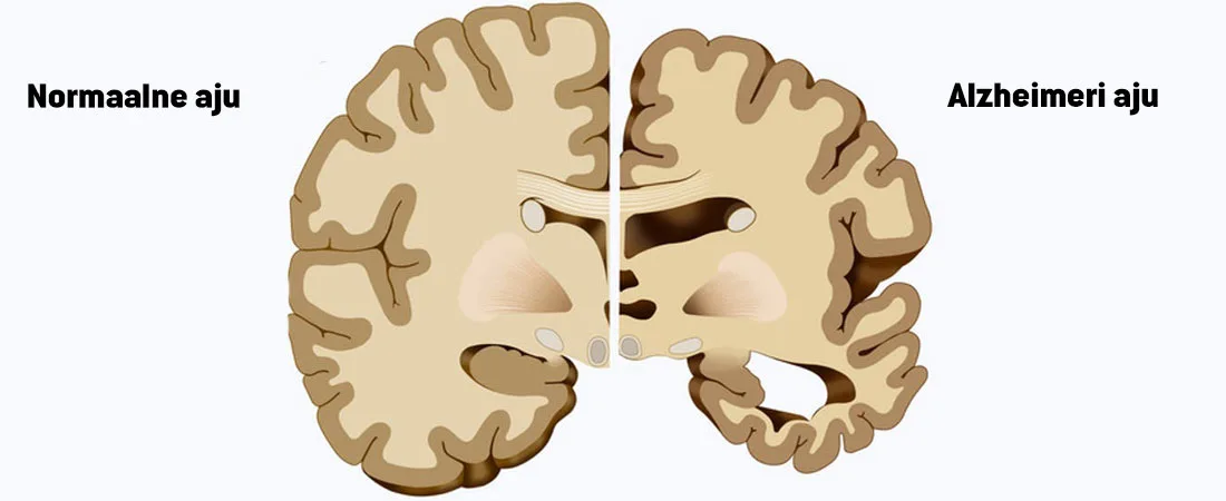 Alzheimeri-aju